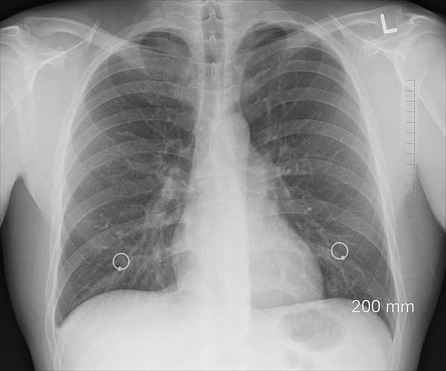 Röntgen pľúc.jpg